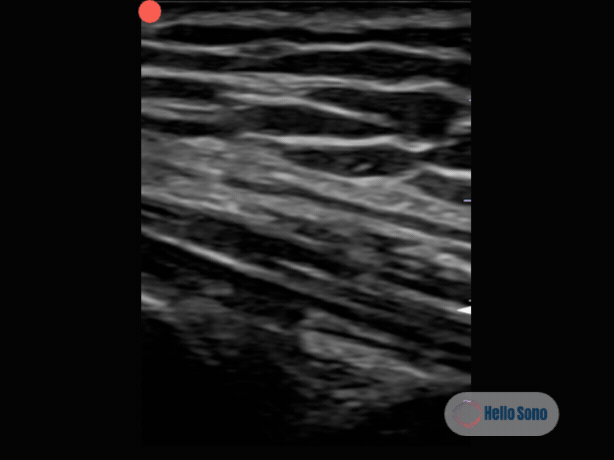 ultrasound clip of the quad tendon in sagittal plane showing anisotropy