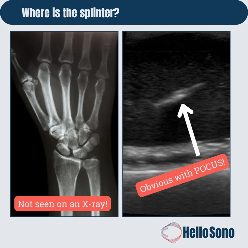 Doctor Splinter Wood Splinter On Ultrasound