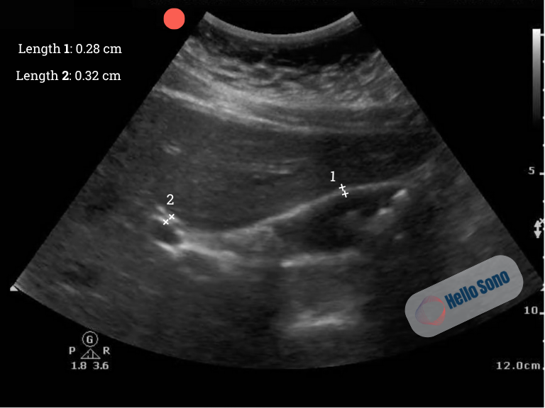 ultrasound image of gallbladder demonstrating gallstones and normal CBD and anterior gallbladder wall measurements