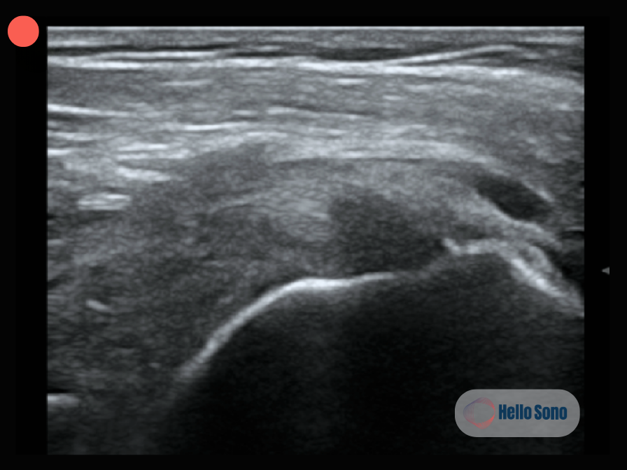 Ultrasound image of supraspinatus tendon showing a partial tear