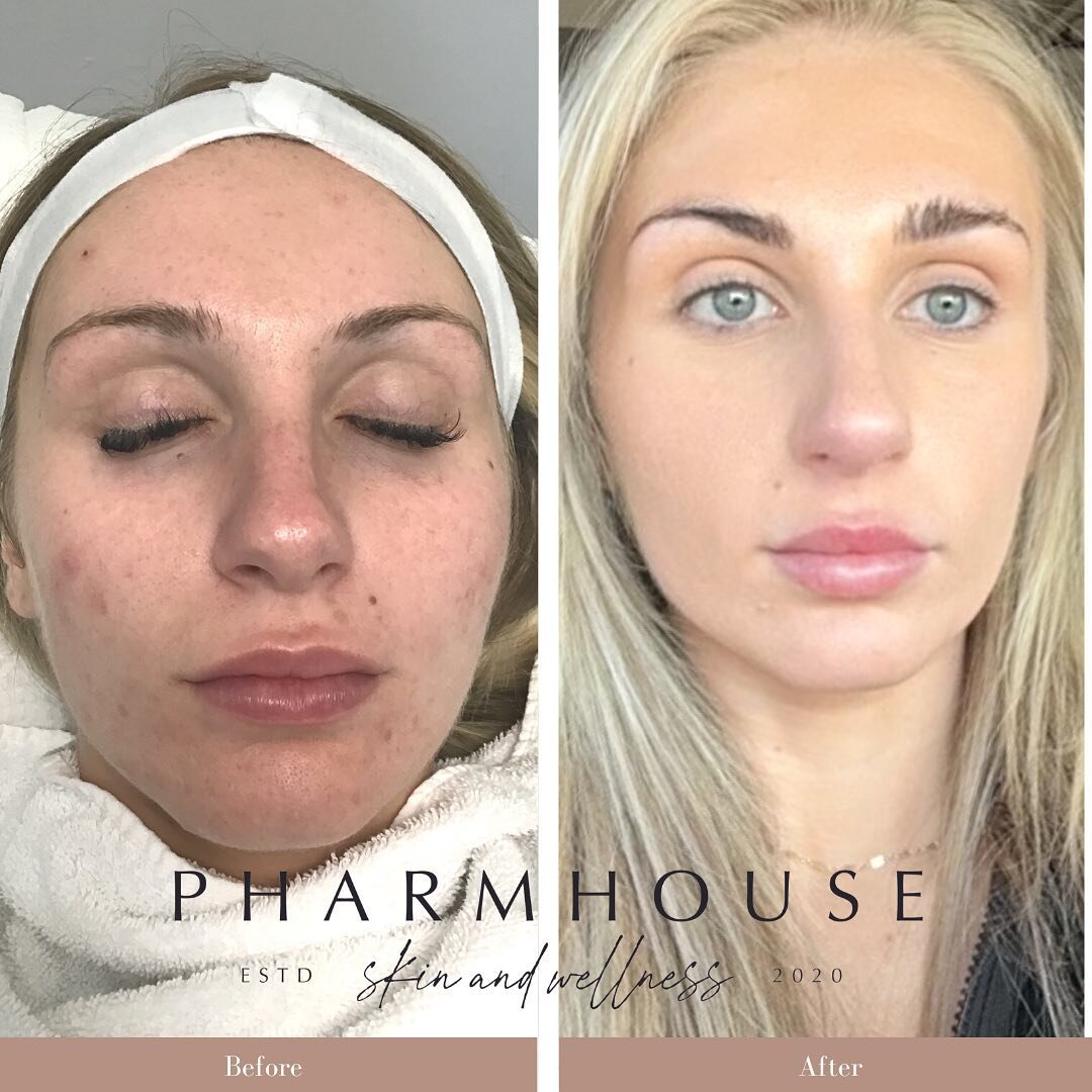 Patient compliance and commitment are necessary to obtain optimal transformations! 

After treating this client for 1.5 years with medical grade skincare, Microneedling with PRP, and now MOXI, her results are absolutely AMAZING!! 
🤩

#moxi #scitonmo