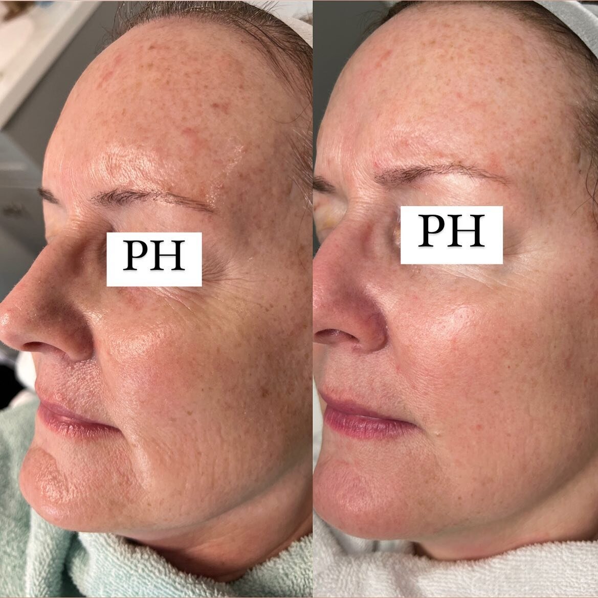 This is the power of MOXI! 

-Before photo on the left. As you can see she has more wrinkles around her eyes, cheeks, and chin.

-After photo on the right. This was taken 1.5 months later after ONE MOXI treatment. 
She had no Botox or changes in skin