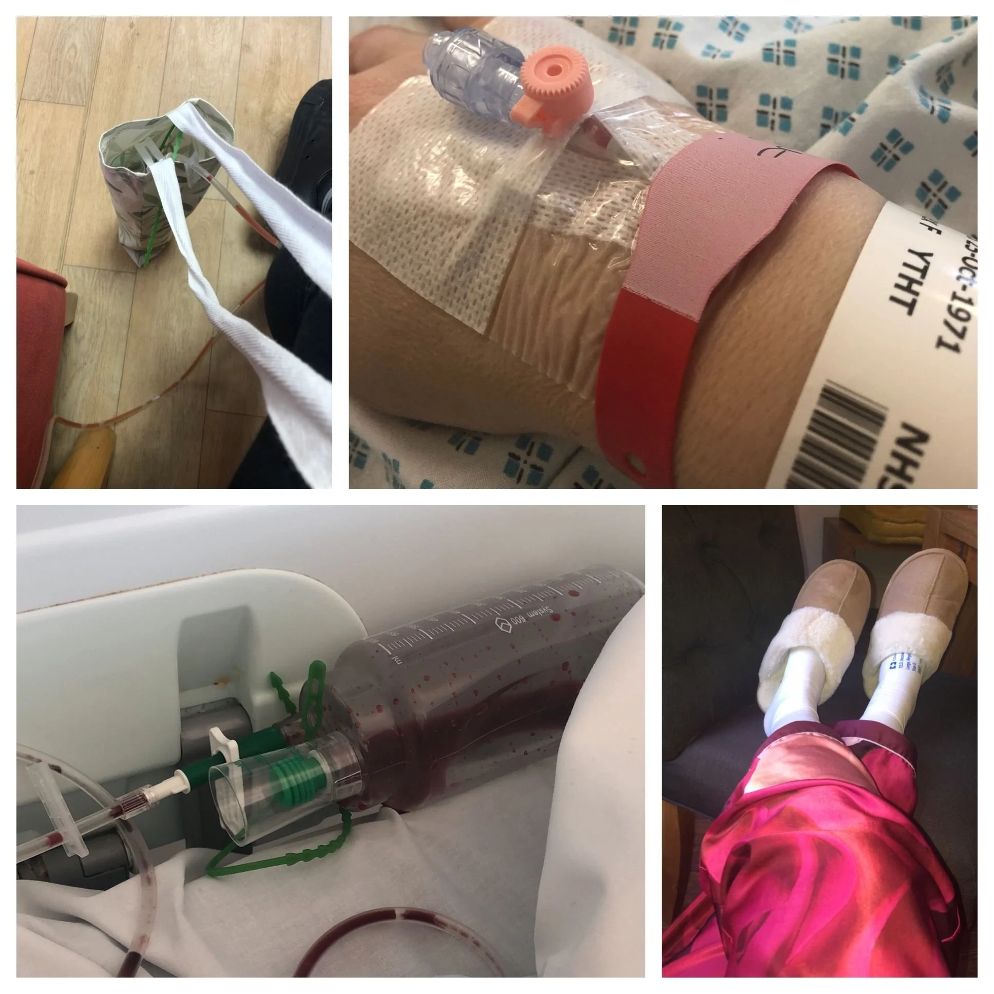 Cannula for pain relief and drain canisters. For a bilateral mastectomy, you can have up to four, I had two. One for each side. (click the image for more information)

Top tip, ask your breast care team for the canvas bags to carry your drains, it ma