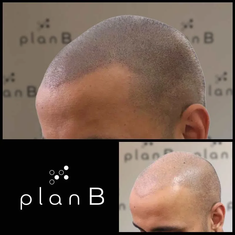 Plan_B_effet_rase2.jpg