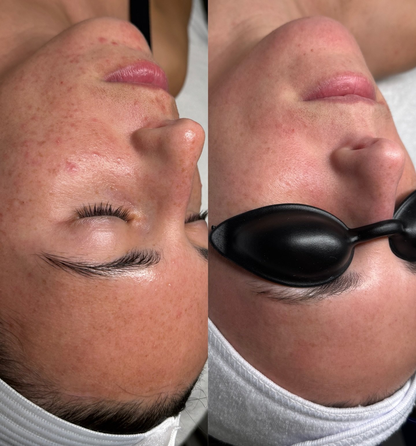 This process is slow and steady! Skin takes time to heal, clear &amp; rebalance. One year later &amp; it&rsquo;s so worth it✨