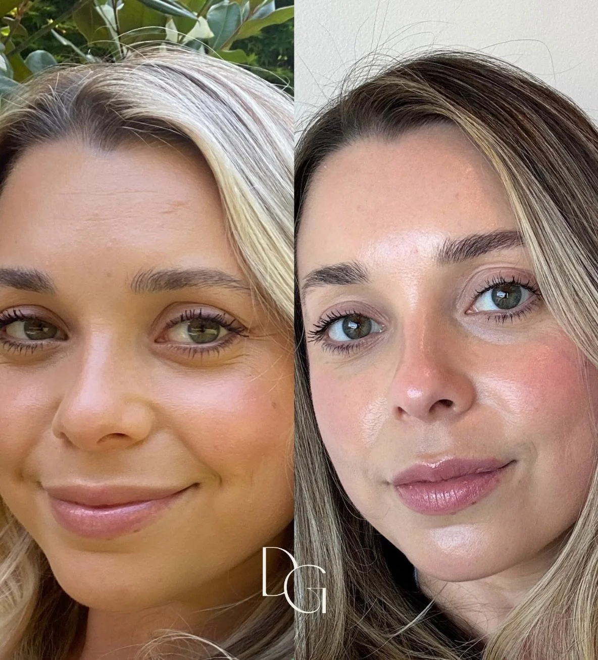 Here&rsquo;s what consistent skincare routines, treatments and face massage look like. I&rsquo;ve been working really hard to smooth, firm my skin, heal my scar &amp; texture! 

A few things my skin loves Nano Channeling, Gua Sha, Proper Exfoliation 
