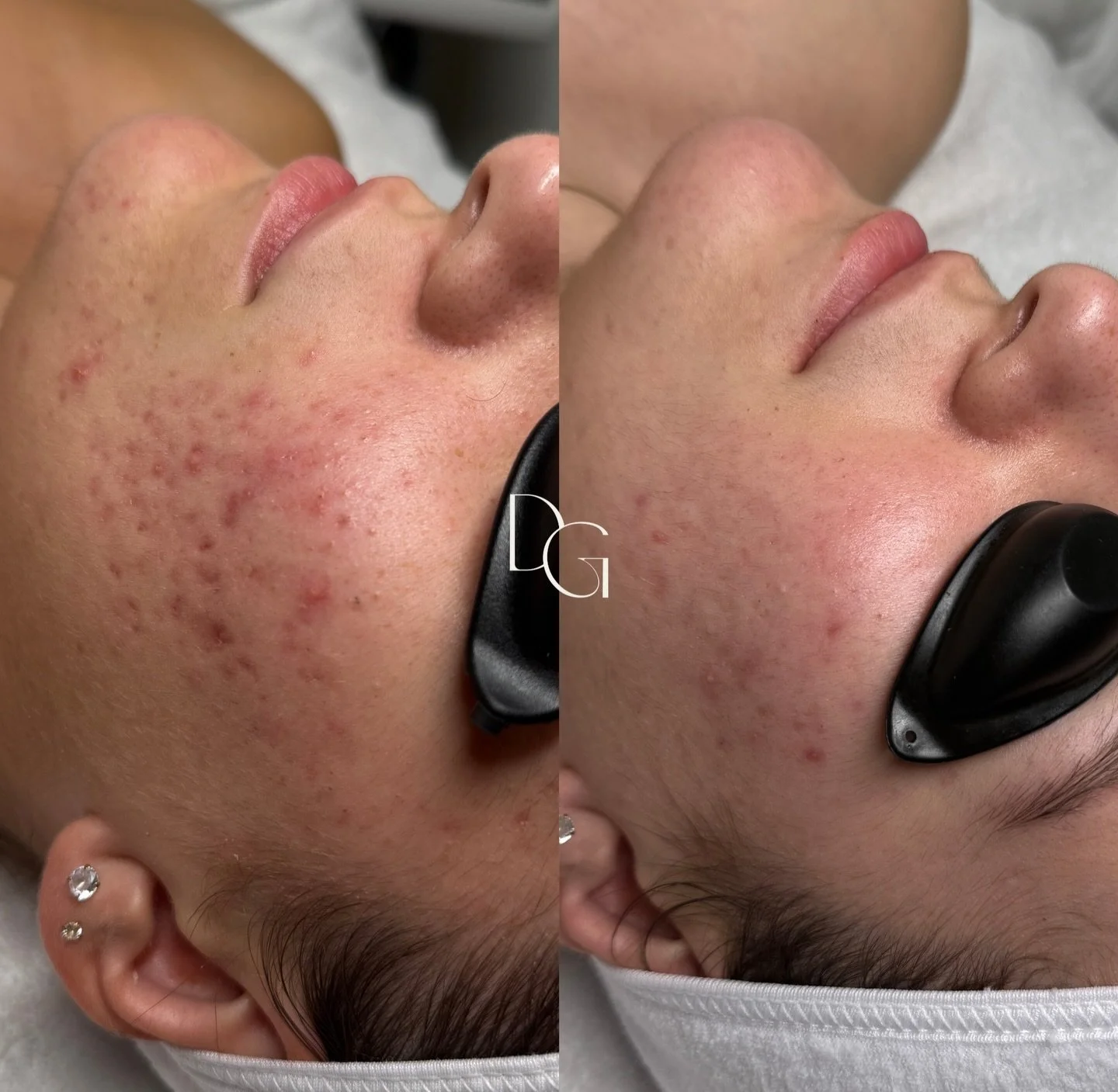 This is what a consistent home routine + facials + your esthetician rooting for you looks like 🪄 one is not more important than the other!