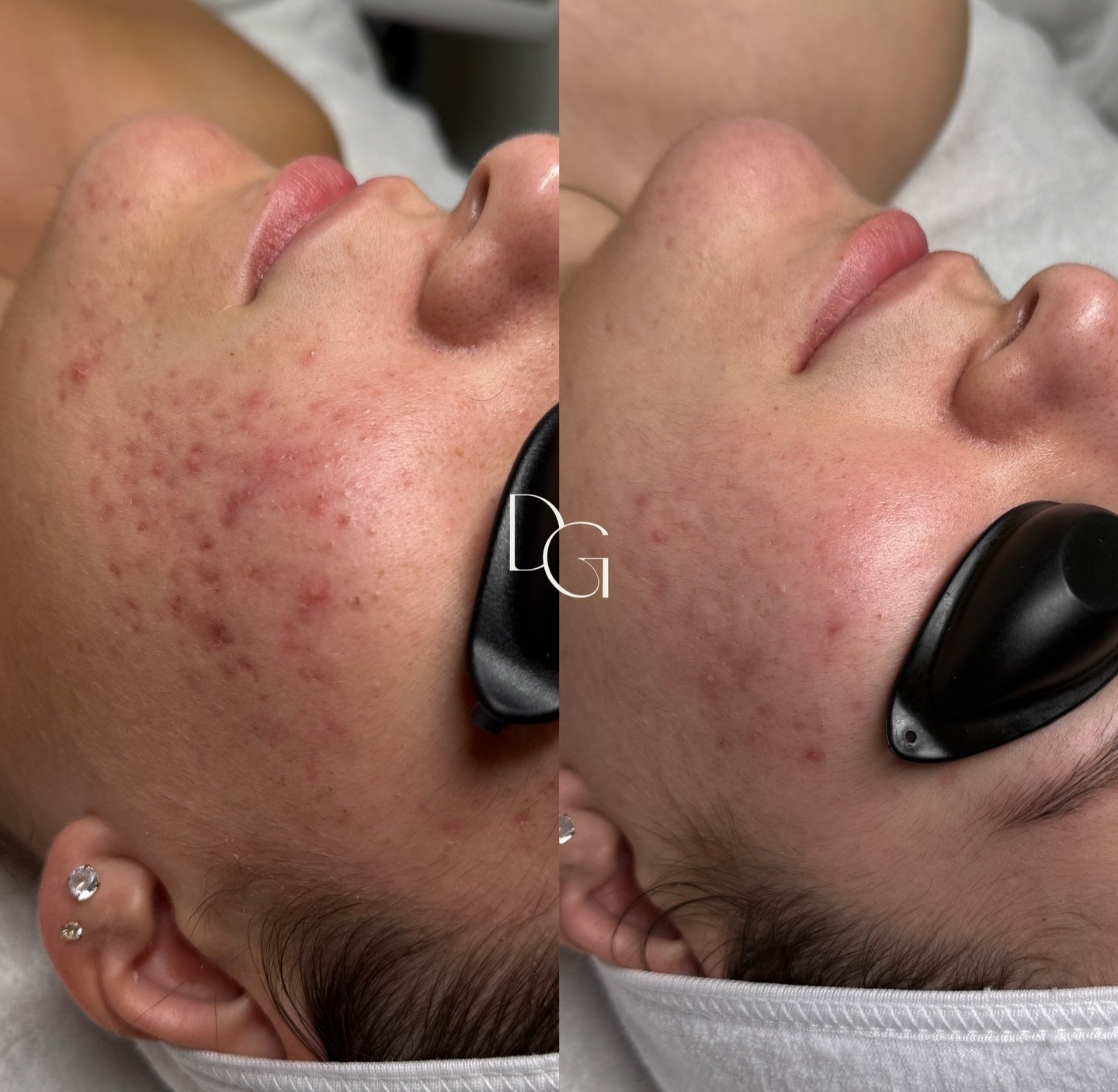 This is what a consistent home routine + facials + your esthetician rooting for you looks like 🪄 one is not more important than the other!