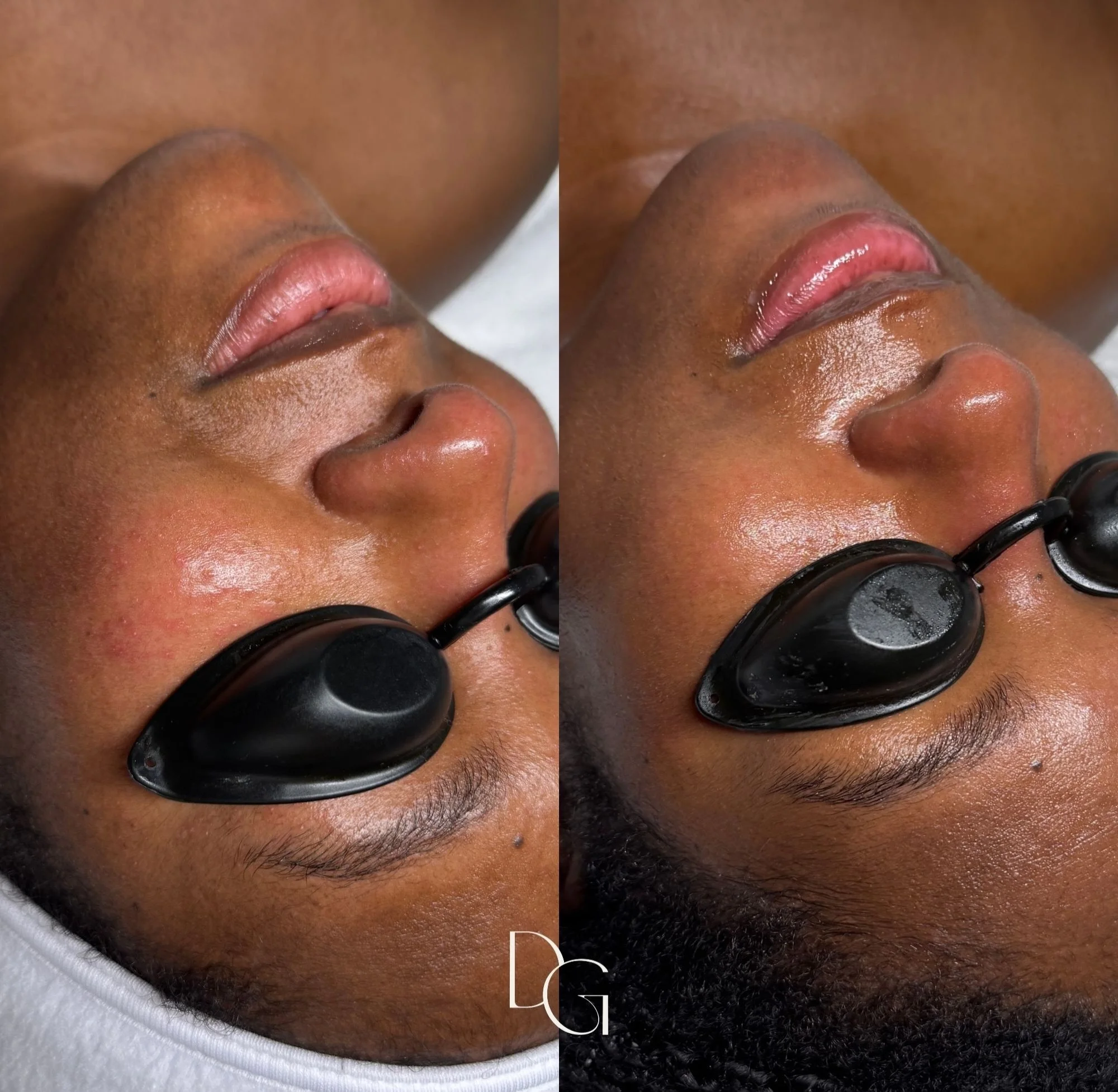 The difference one facial can make! Results don&rsquo;t happen the same for everyone. They come with consistency. The more consistent you are with your treatments, the better your skin is able to bounce back 🪩