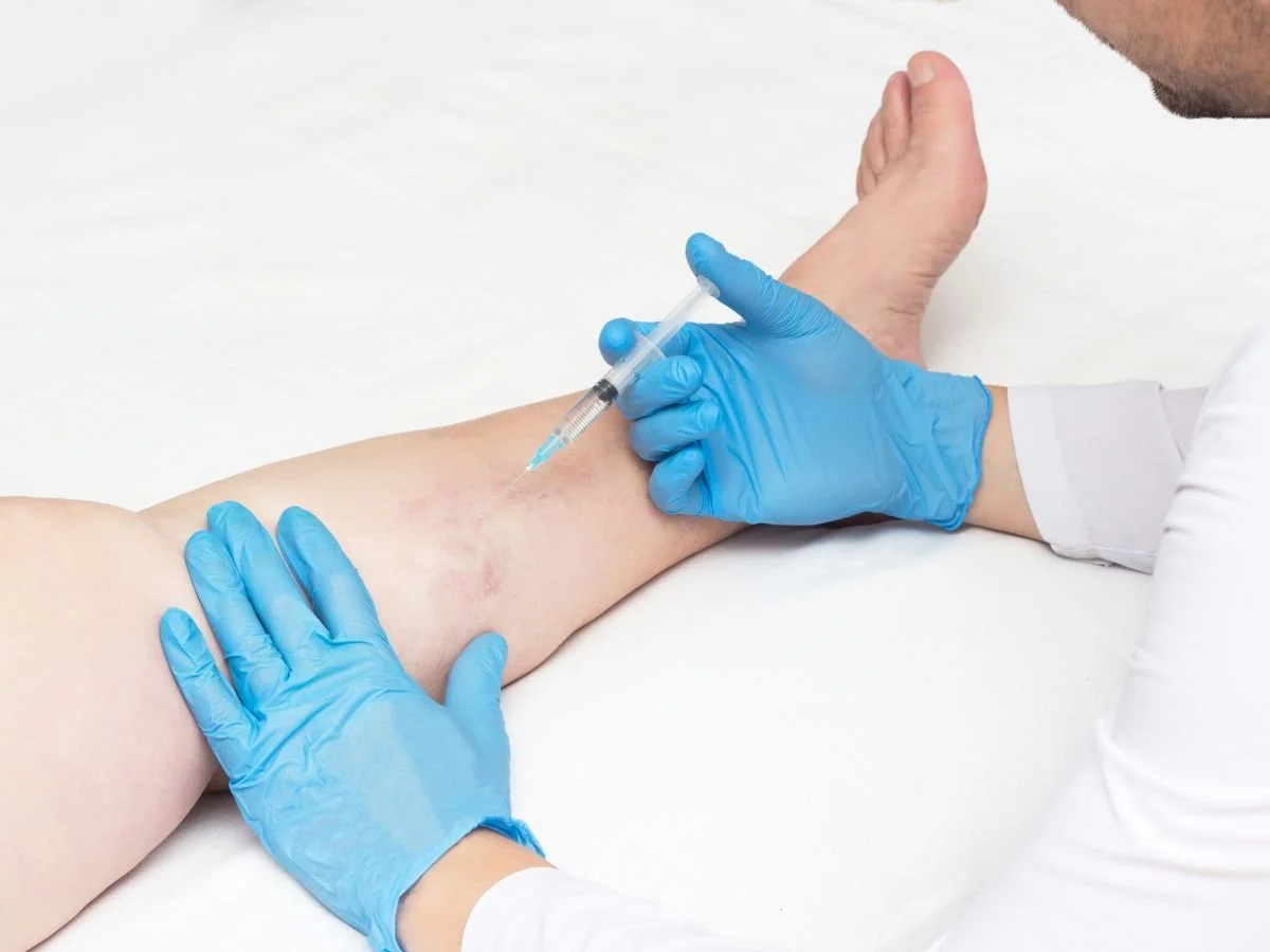 How Sclerotherapy Works.jpg