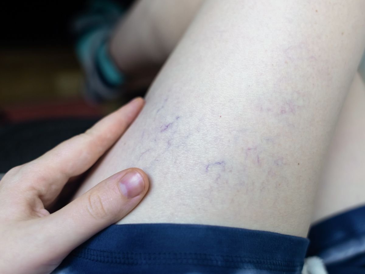 How Sclerotherapy Works and Why Veins Change Appearance