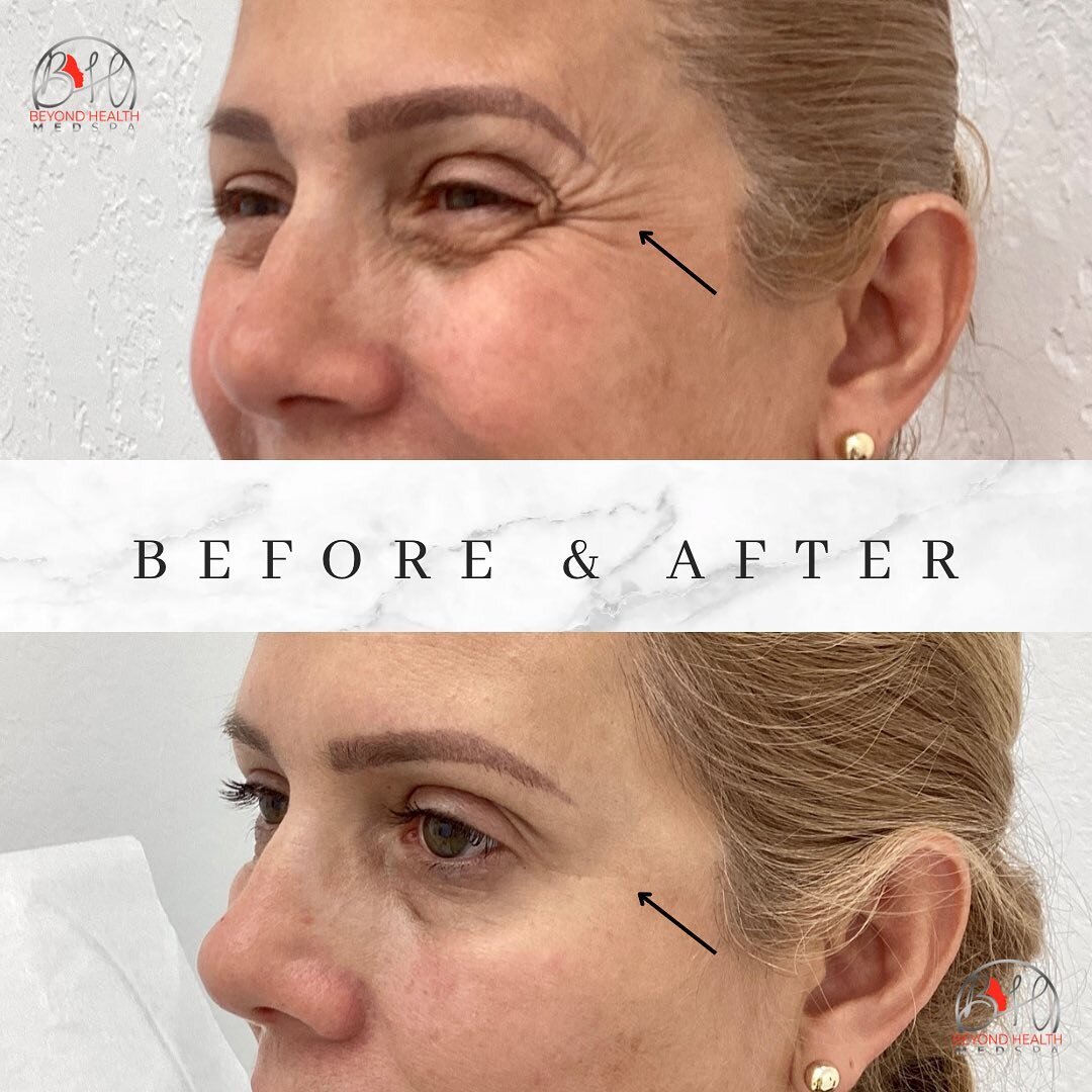 Before &amp; After: The Power of Botox! ⭐ Unveil a new, rejuvenated you with our expert team at Beyond Health MedSpa. Say goodbye to fine lines and wrinkles and hello to a revitalized appearance.

Book your free consultation today and let&rsquo;s mak