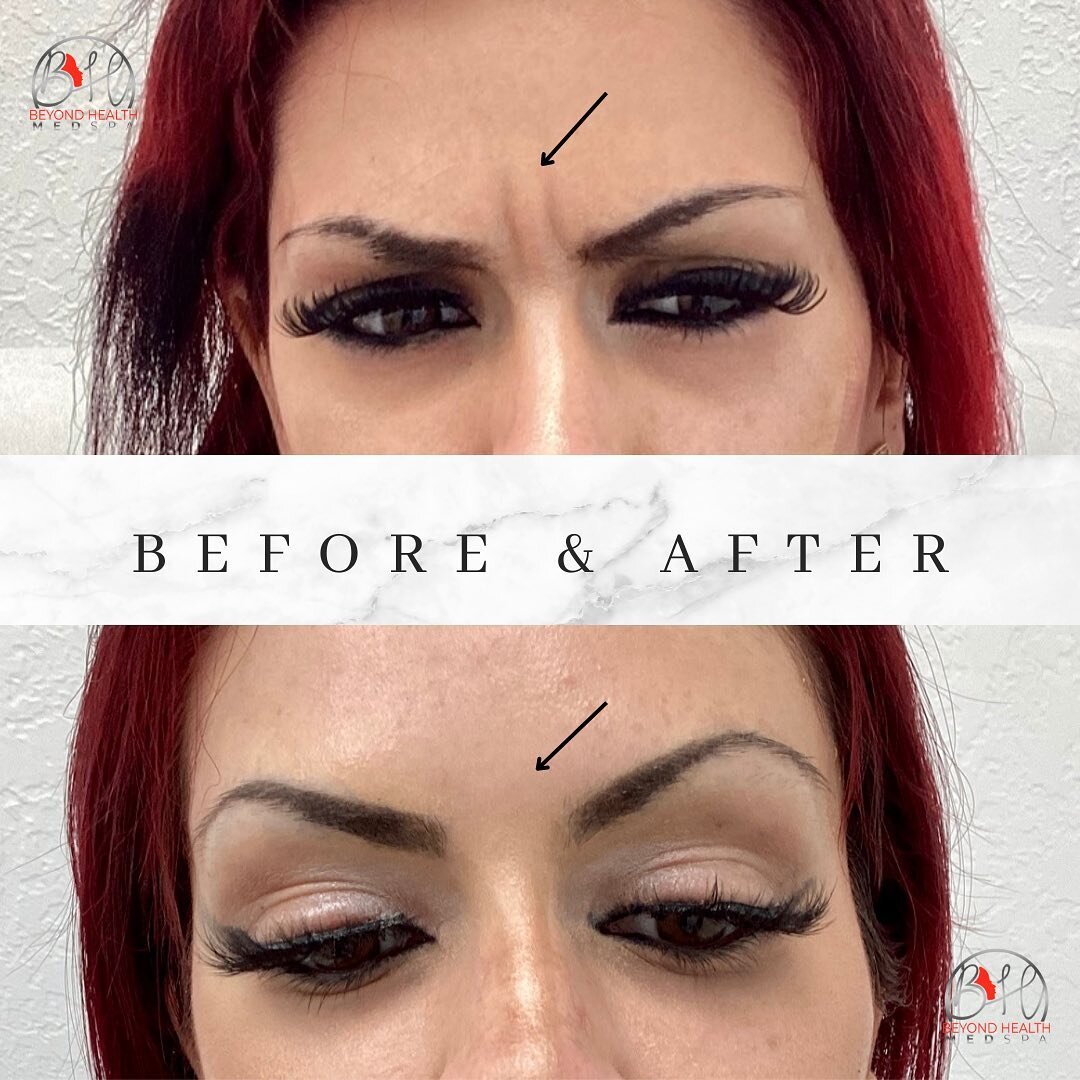 Turn Your Frown Upside Down with Botox for the Glabella! 😊 No more &lsquo;11 lines&rsquo; making you look stressed or angry. Uncover a smoother, more relaxed version of yourself in just one visit.

Ready for a more approachable, youthful look? Let&r