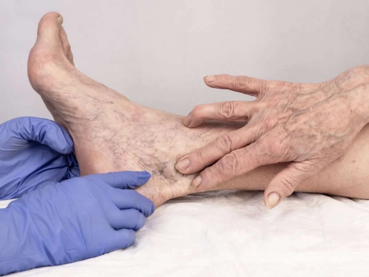 What to Expect Before and After Sclerotherapy Treatment