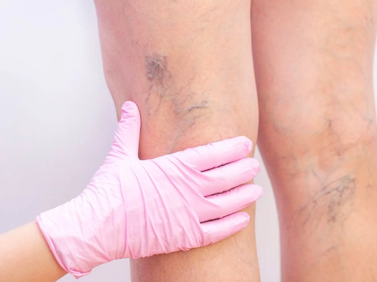 How is sclerotherapy performed