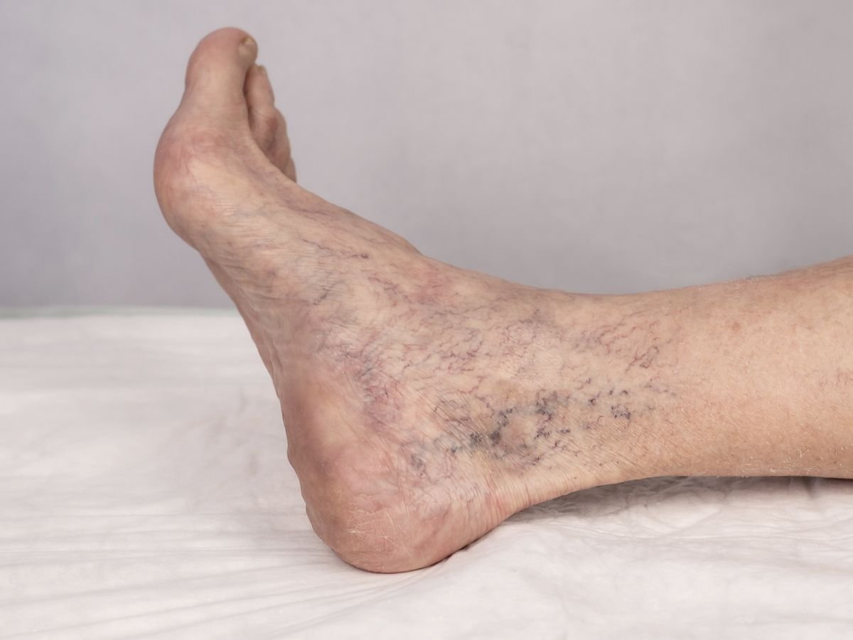 Why Are My Veins Darker After Sclerotherapy?