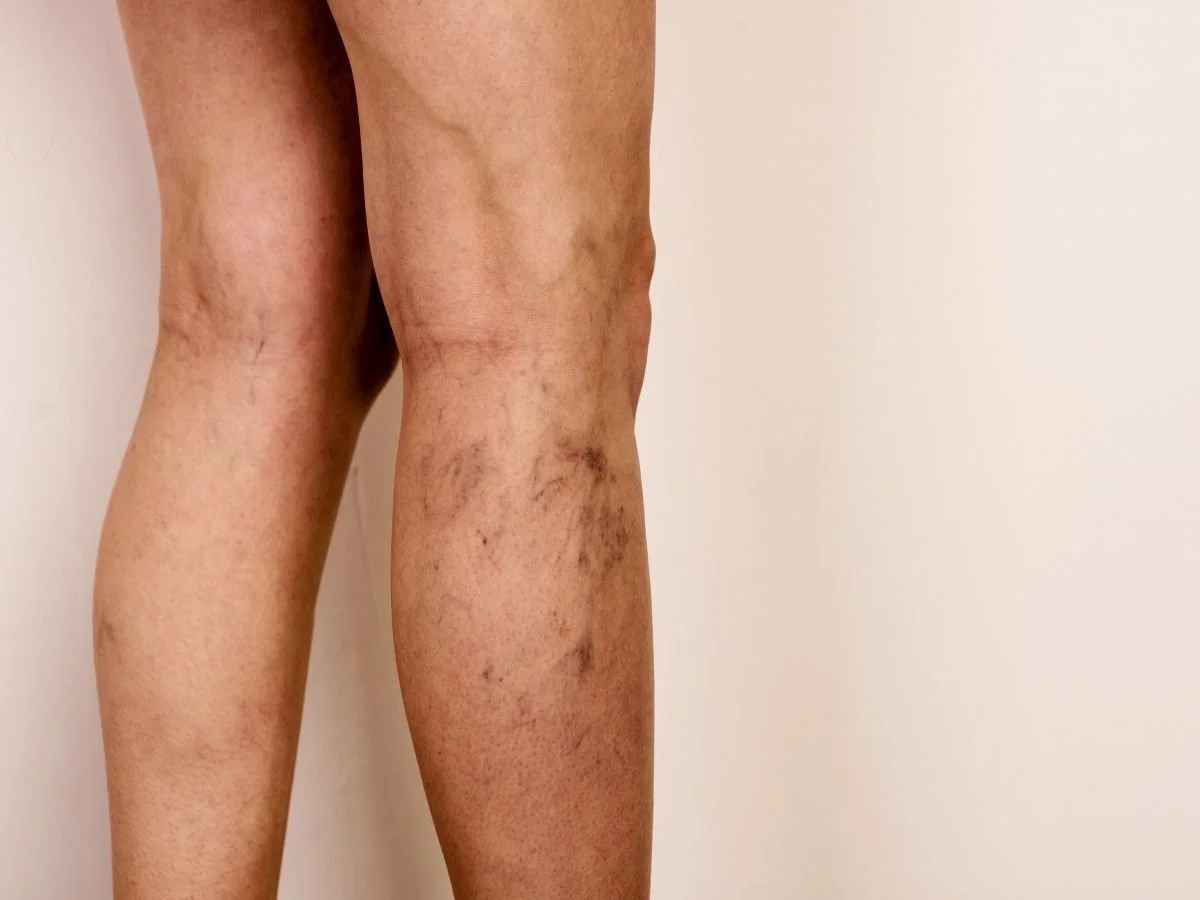 When Should Spider Veins Be Treated? A Miami Guide