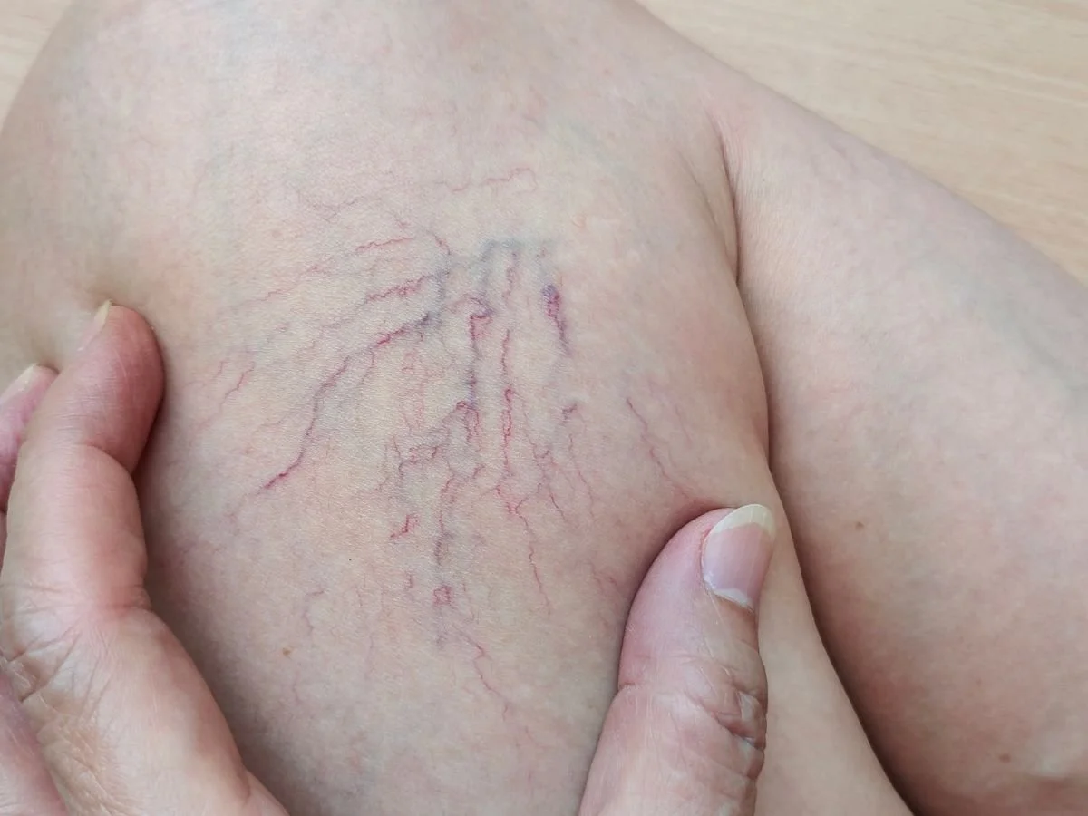 What Causes Spider Veins on the Legs?