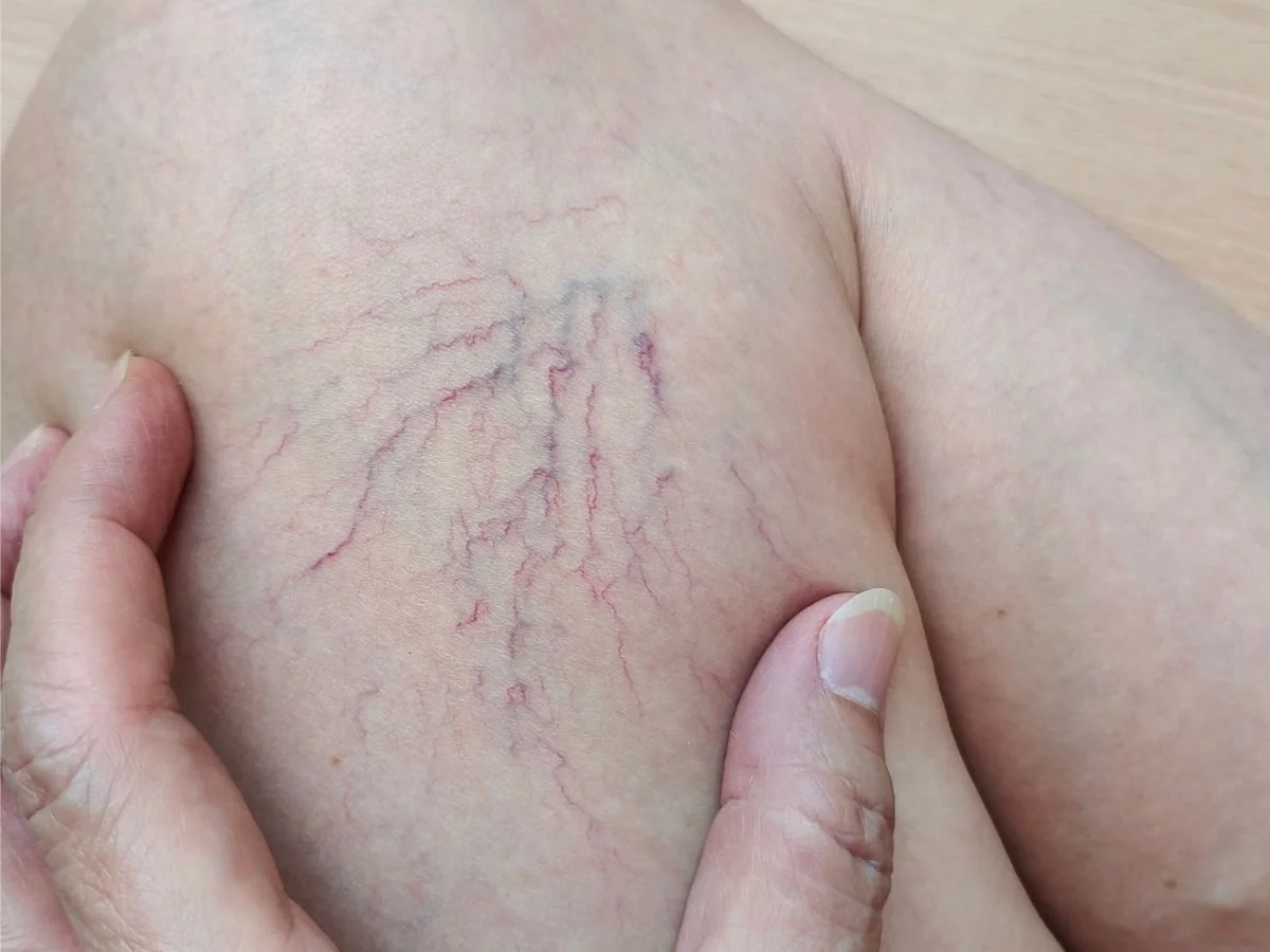 Are Spider Veins Preventable? What Miami Patients Should Know Before Treatment