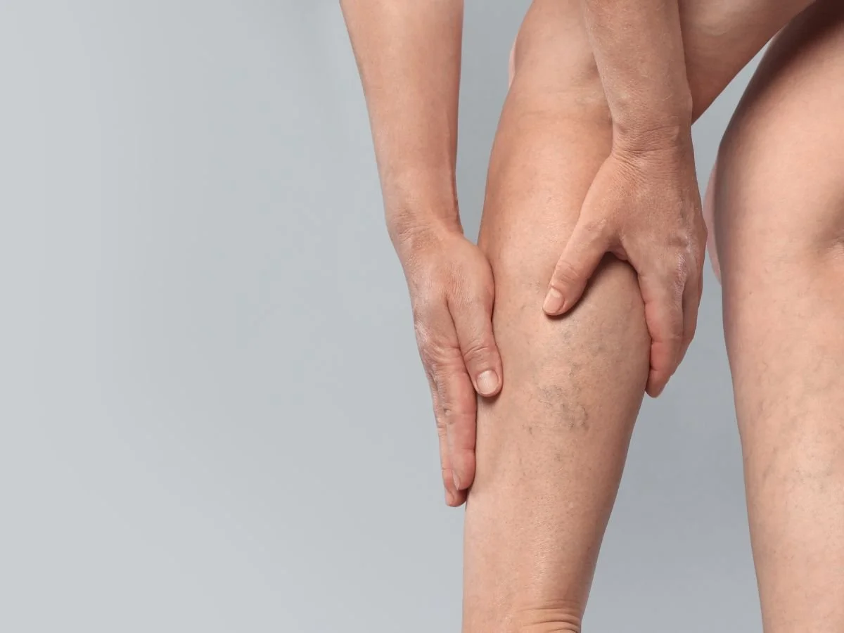 Why Are Spider Veins More Common in Women? Understanding the Link Between Hormones, Pregnancy, and Vein Health
