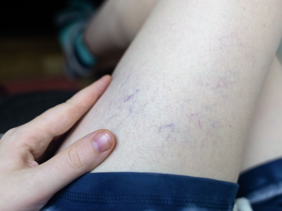Lumps After Sclerotherapy