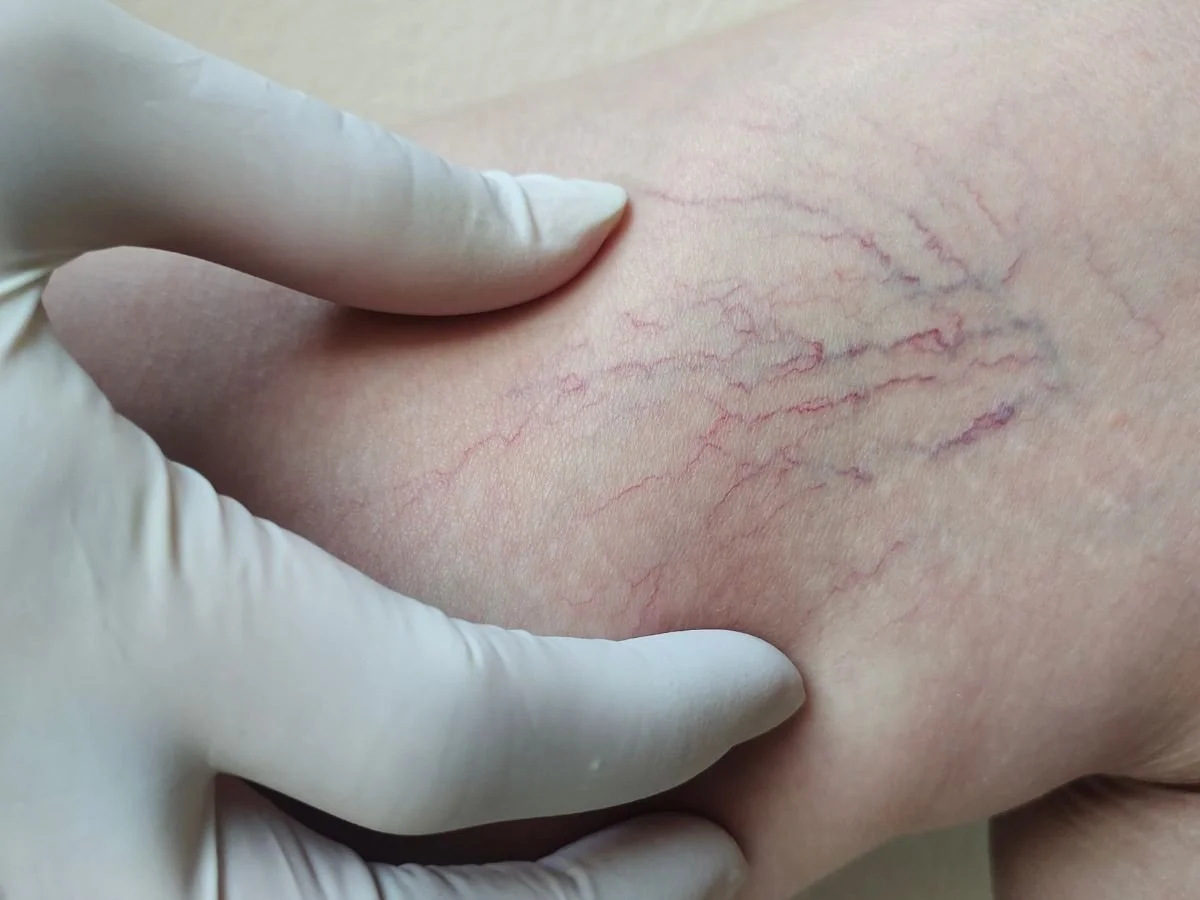 Why Do Spider Veins Itch?