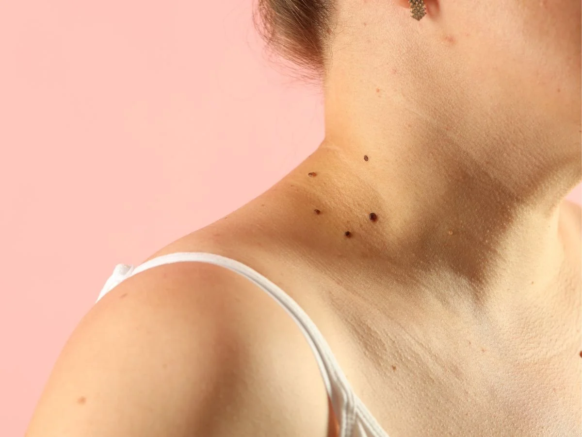 Skin Tag Symptoms