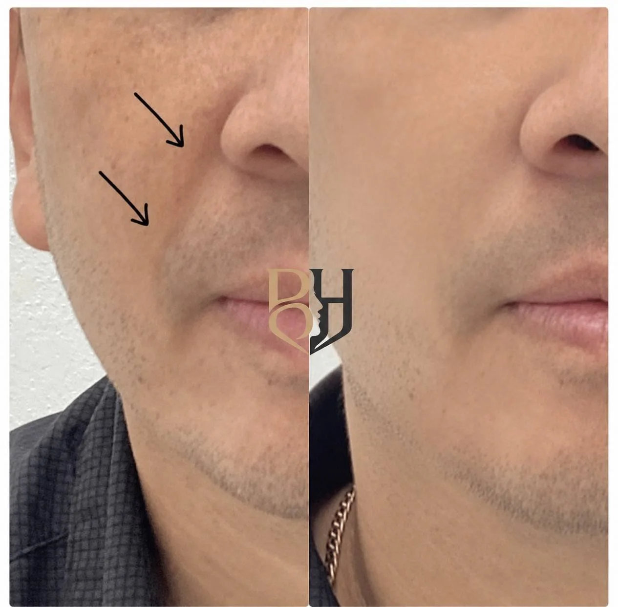 Dermal fillers real results image 1