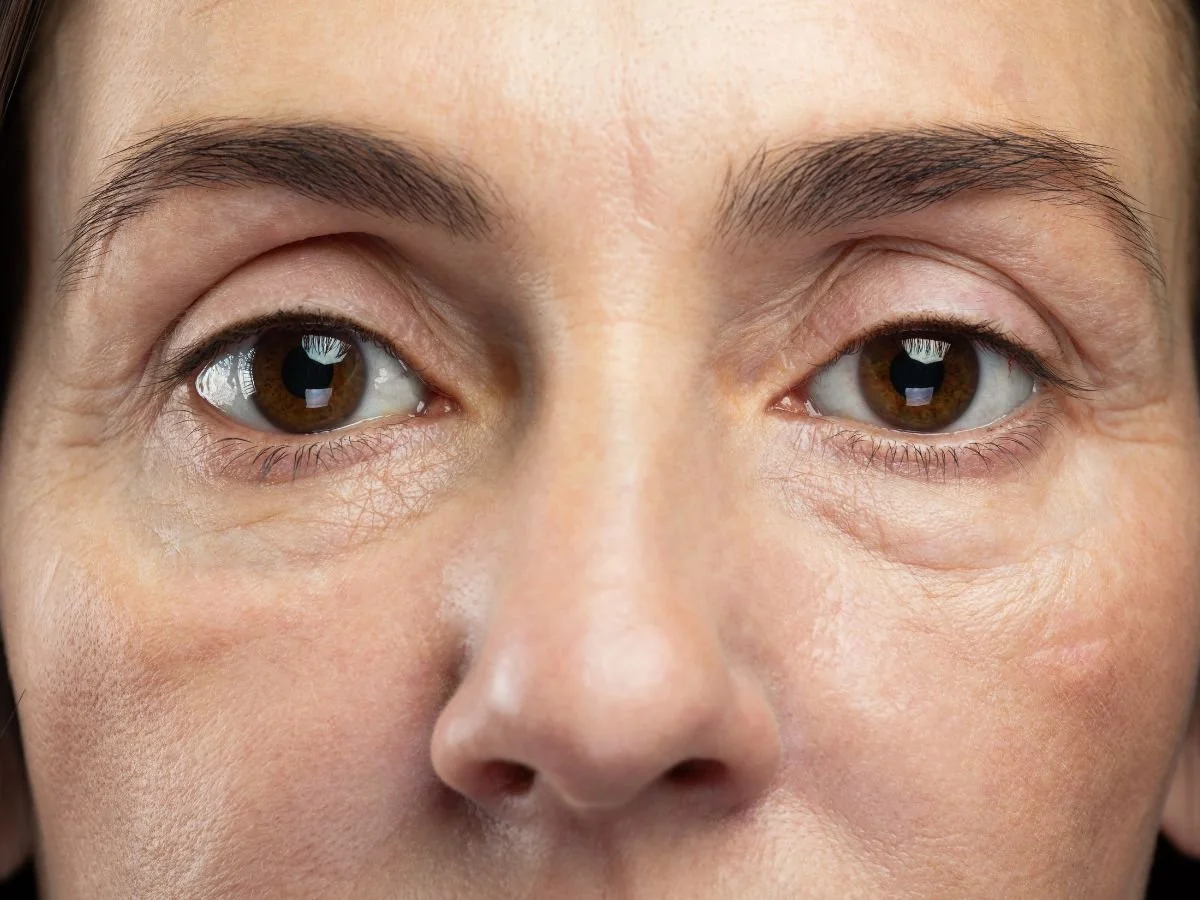 Is Endolift Right for Your Eye Area