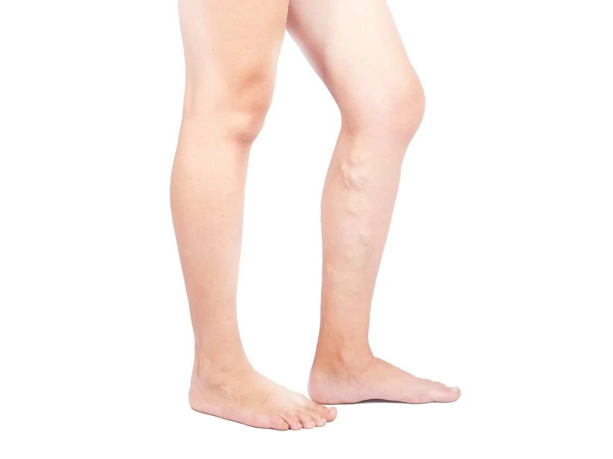 What Other Activities Should You Avoid During Sclerotherapy Recovery?.jpg