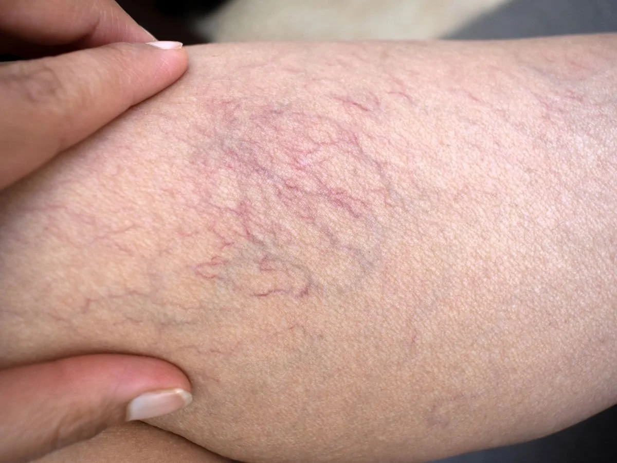 When Should You Have Spider Veins Checked.jpg