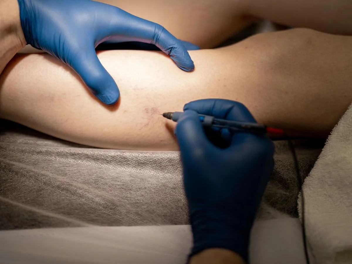Does Foam Sclerotherapy Hurt More?