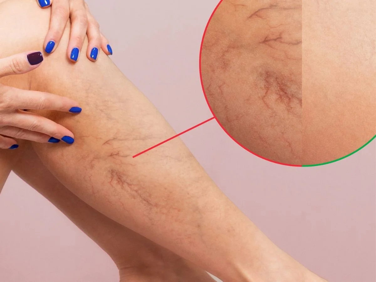 Can Sclerotherapy Help Spider Veins?