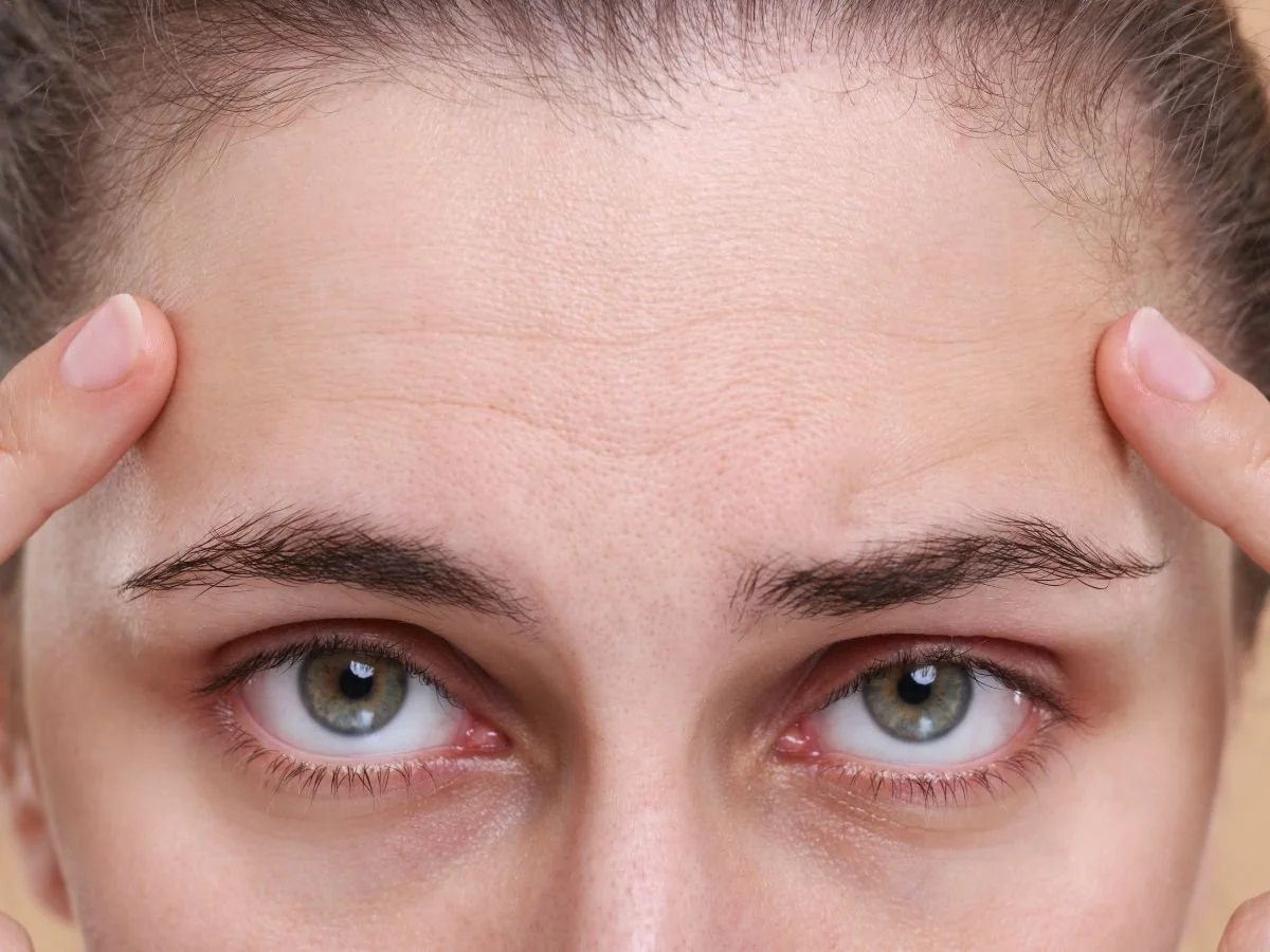 HOW ENDOLIFT TARGETS THE BROW AND FOREHEAD