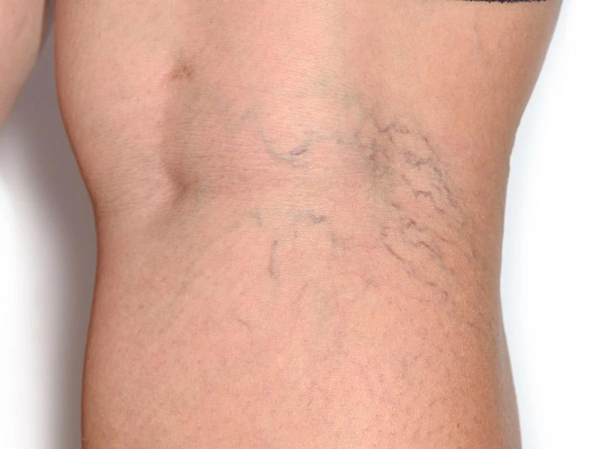 What If You Already Have Spider Veins?