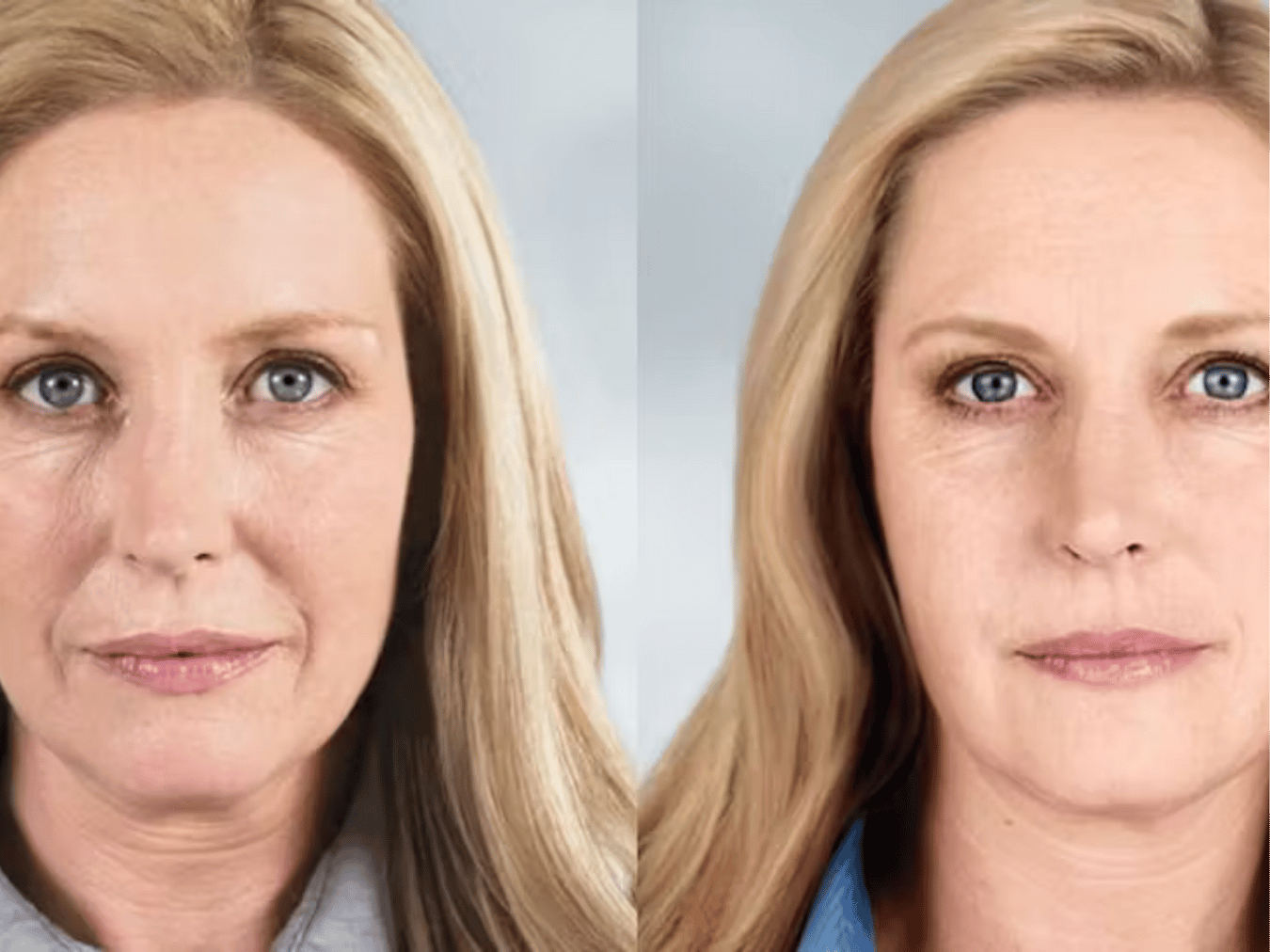 How Much Does Sculptra® Cost?