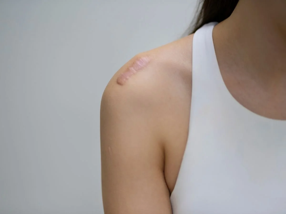 Keloids with Professional Treatment in Miami