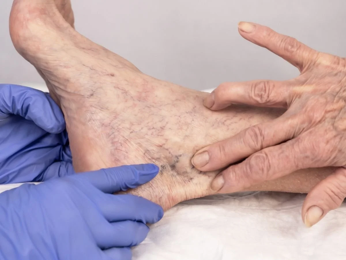 How Long Does Vein Darkening Last?