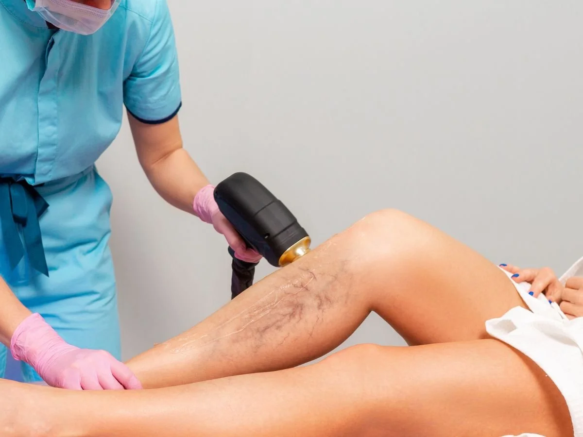 Can You Prevent Hereditary Spider Veins?