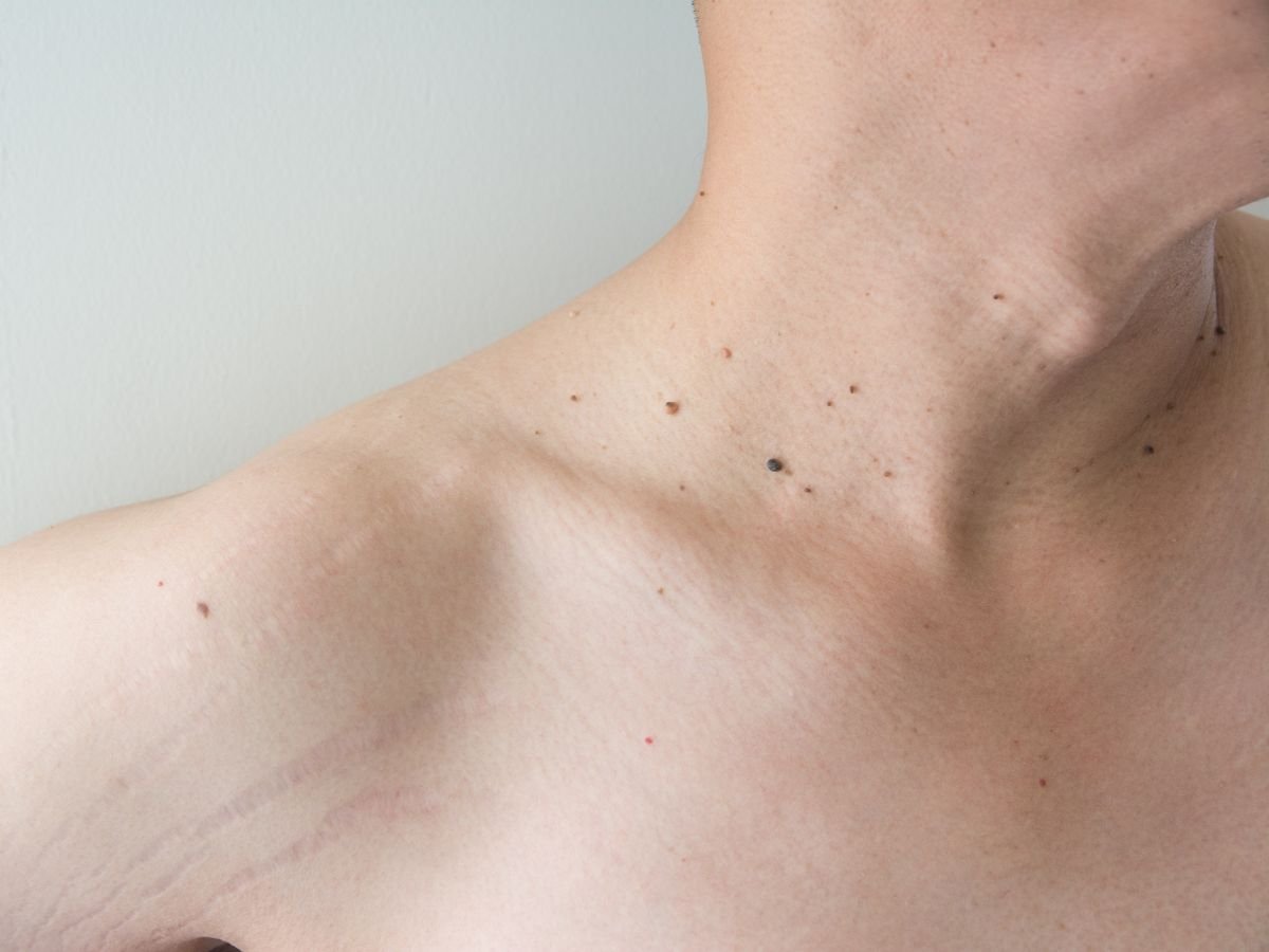 How Much Does Skin Tag Removal Cost In Miami?