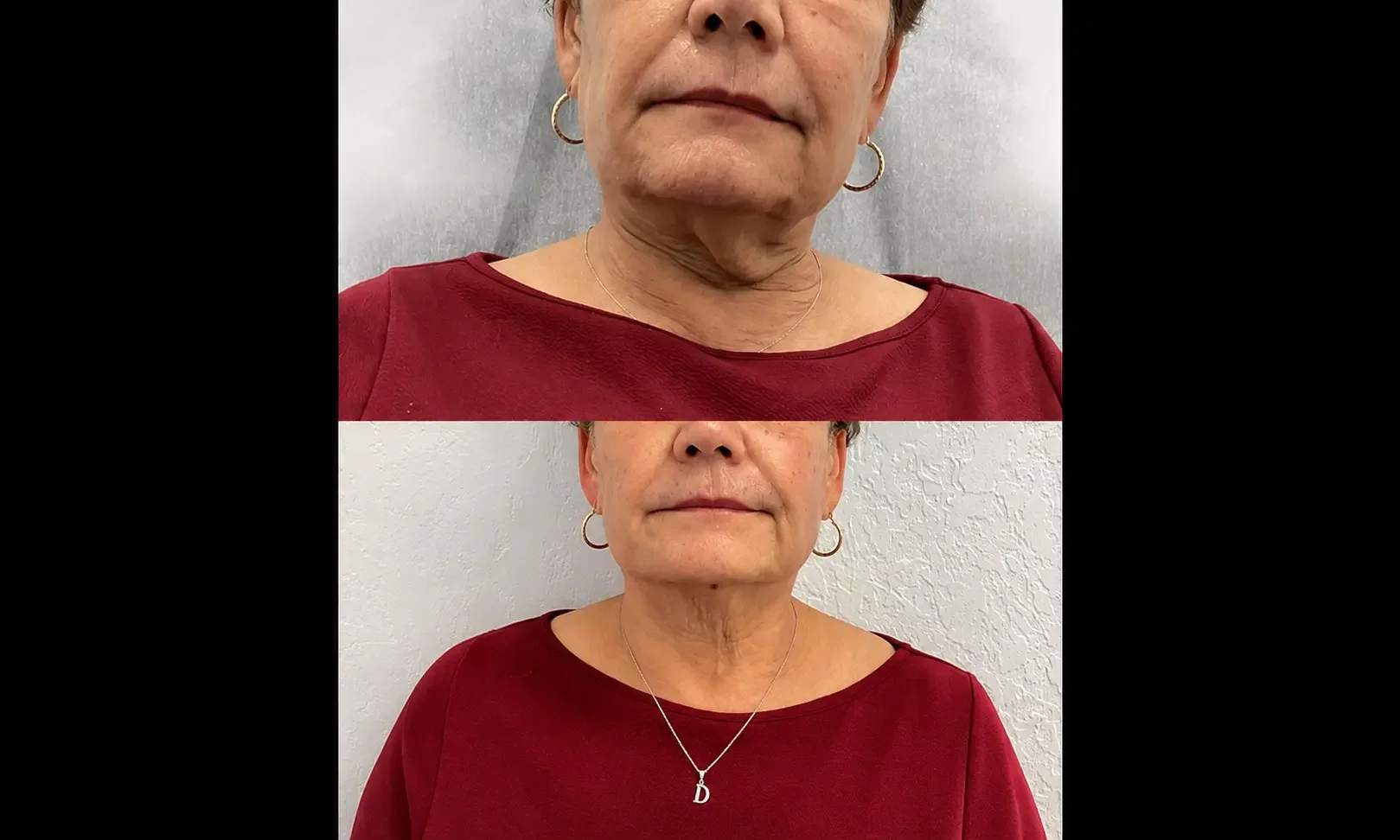 Resultados antes y después de Endolift