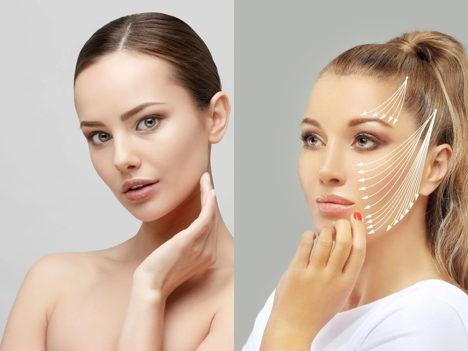 Endolift vs Kybella