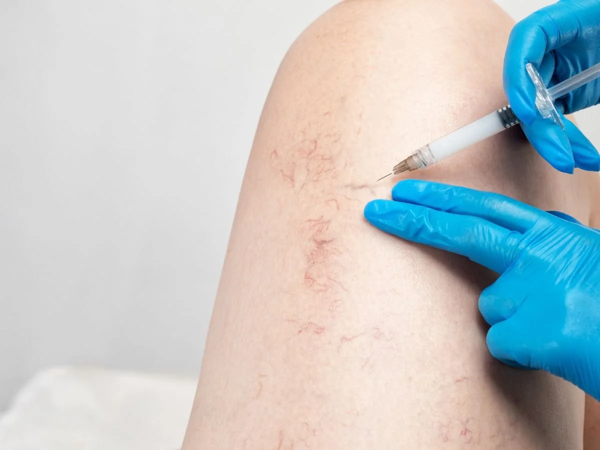 Where Does Sclerotherapy Fit?