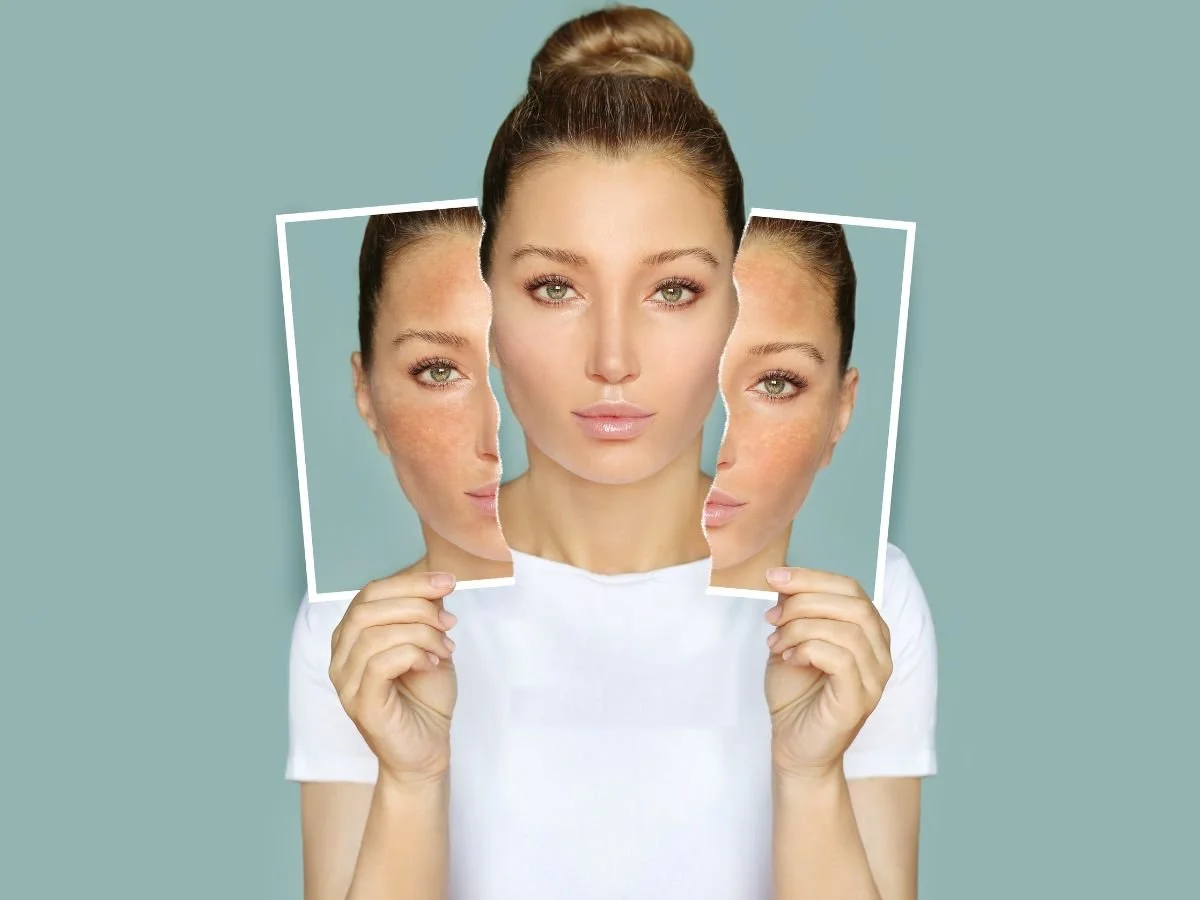 Am I a Good Candidate for Endolift + Threads