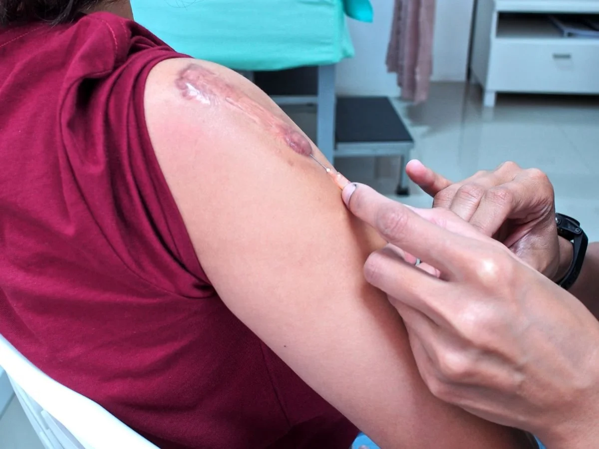 How Much Does Keloid Treatment Cost in Miami?