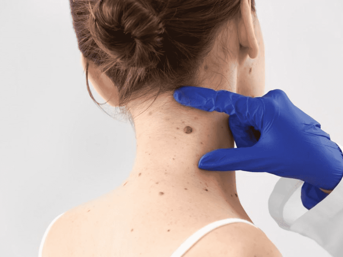 Skin Tag Removal Miami