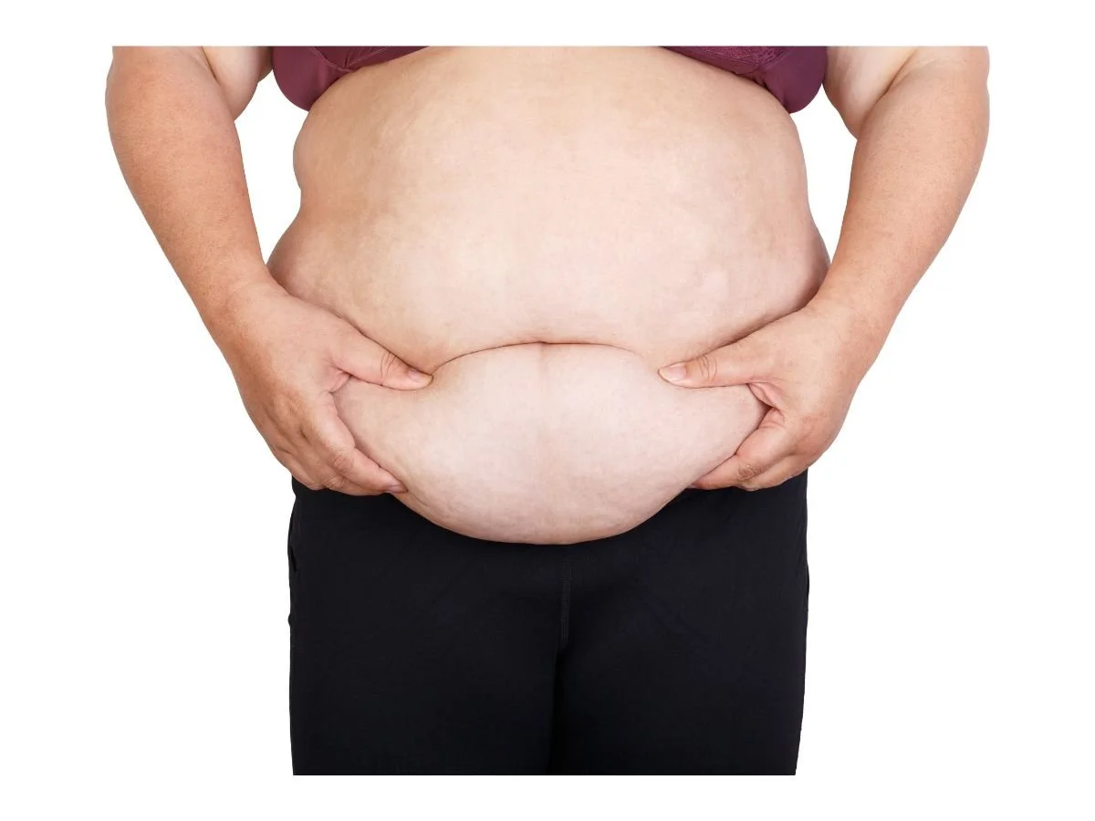 Kybella for Permanent Fat Reduction