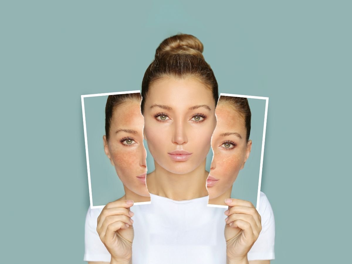 What is Endolift A Simple Look at a Powerful Treatment