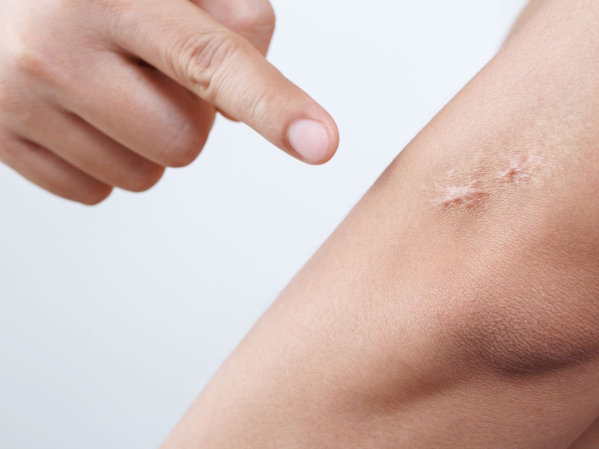 Potential Downsides of Keloid Scar Treatment