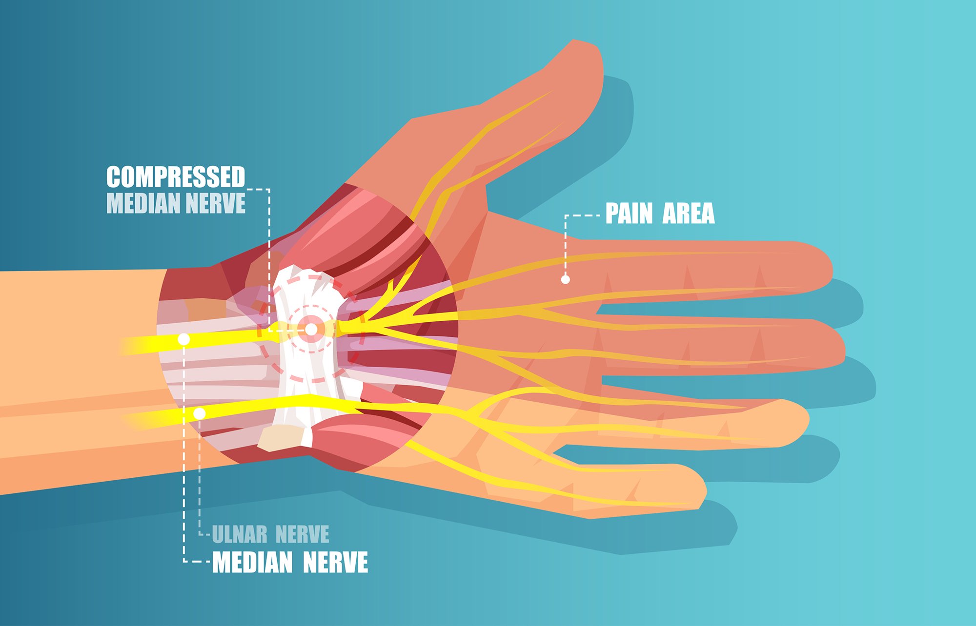 What is Carpal Tunnel Syndrome? — Orthopedics Hawaii